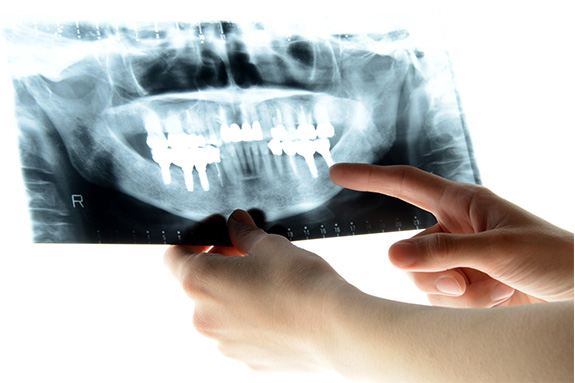 写真：歯周病治療のイメージ